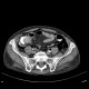Pneumoretroperitoneum, pneumomediastinum, complication of colonoscopy: CT - Computed tomography